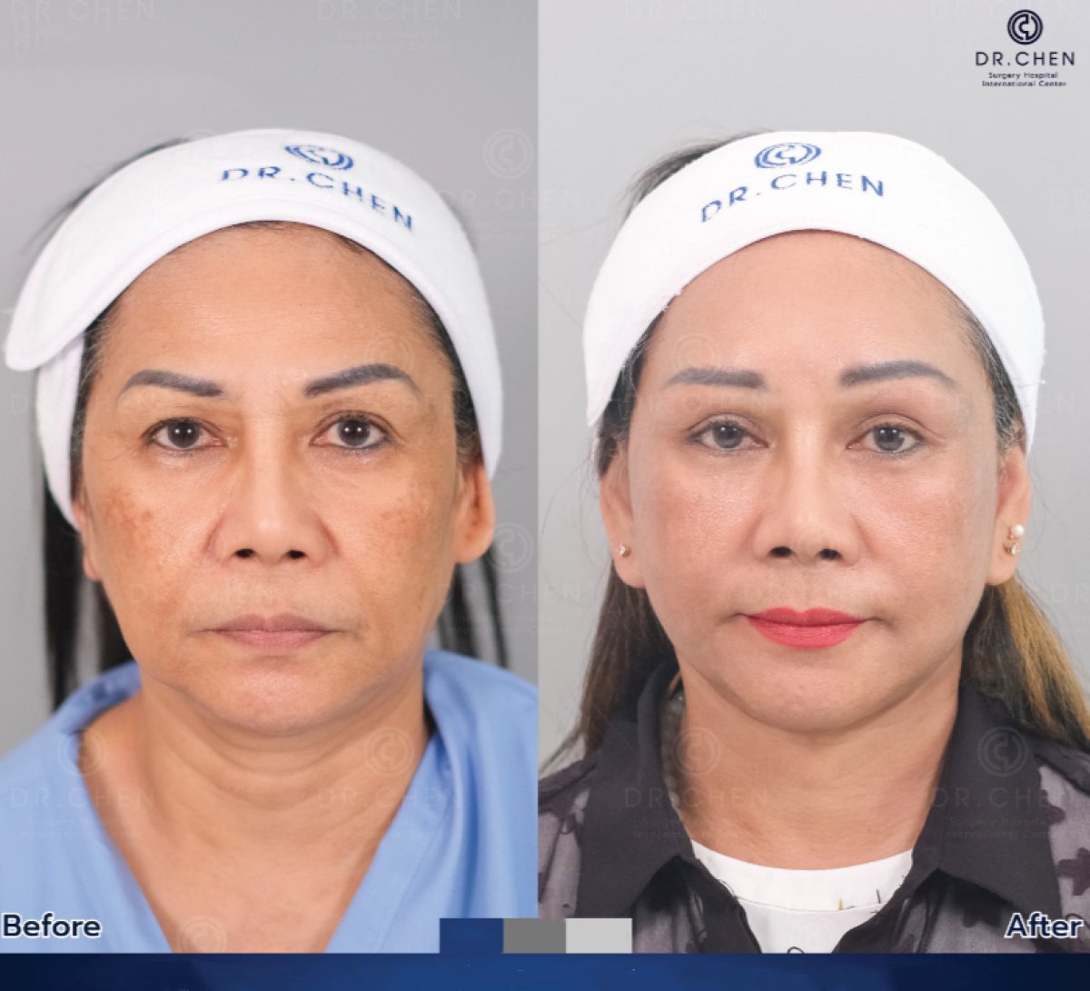 Antes y después de transferencia de grasa facial en Dr. Chen Surgery Hospital International Center, resultado rejuvenecedor