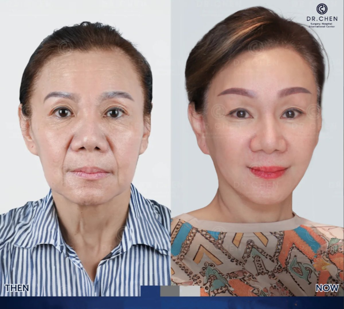 Resultados de transferencia de grasa facial antes y después en Dr. Chen Surgery Hospital