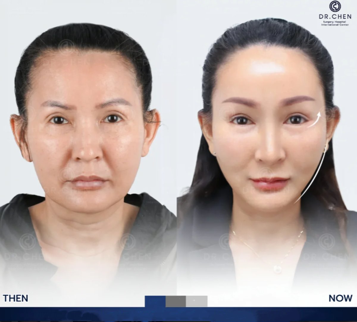 نتائج شد الوجه قبل وبعد في Dr. Chen Surgery Hospital International Center، تجديد شباب الوجه
