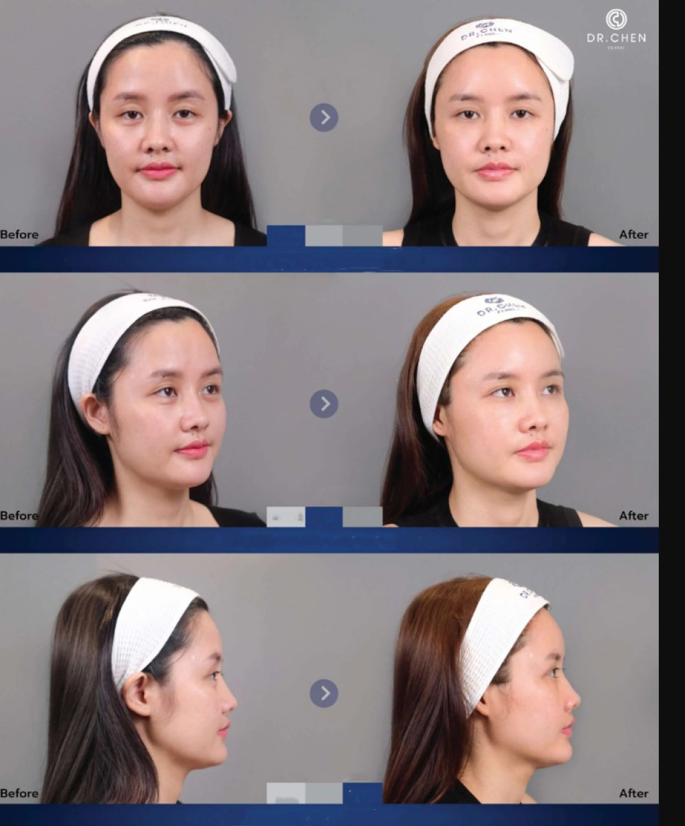 Результат до и после инъекций филлеров в Dr. Chen Surgery Hospital International Center, контур лица