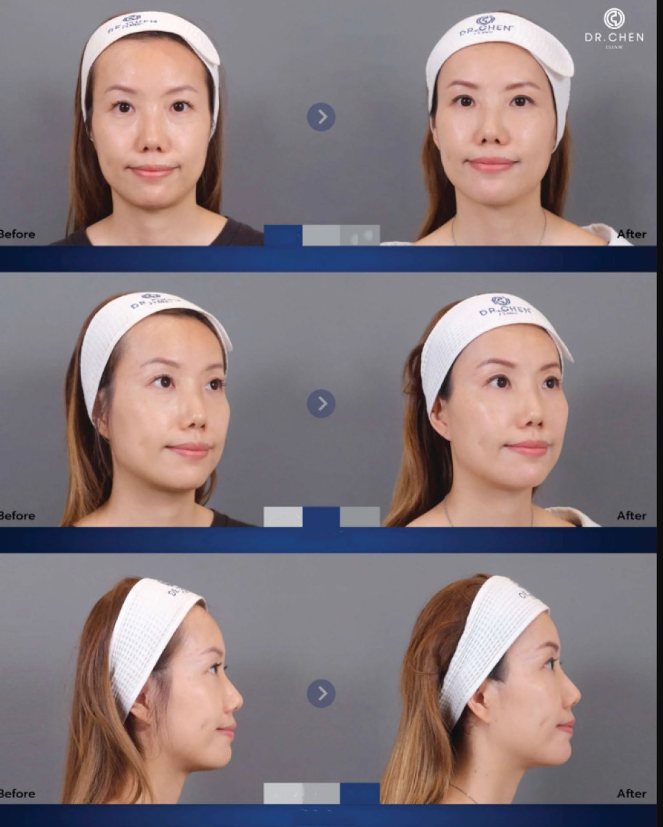 Результат до и после инъекций филлеров в Dr. Chen Surgery Hospital International Center, контур лица