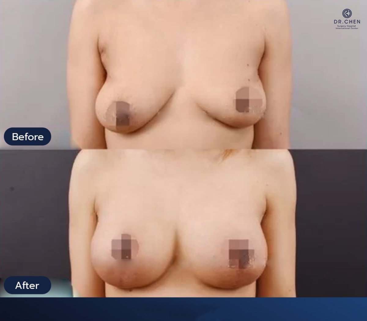 Результаты до и после подтяжки груди в Dr. Chen Surgery Hospital International Center