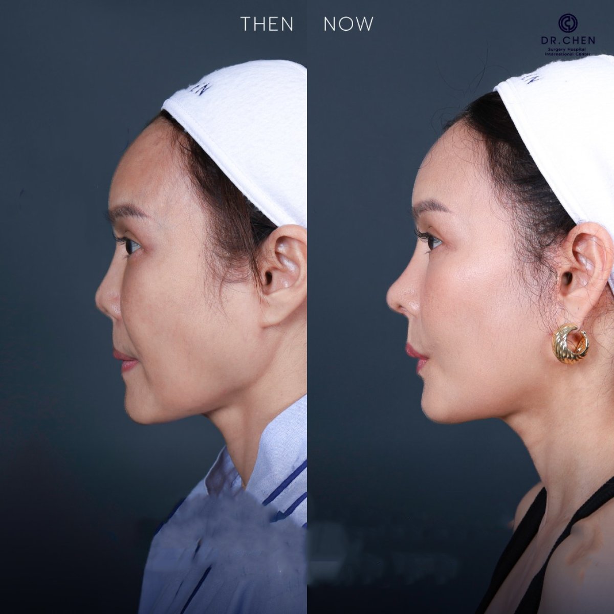 Результат до и после ультразвуковой ринопластики в Dr. Chen Surgery Hospital International Center