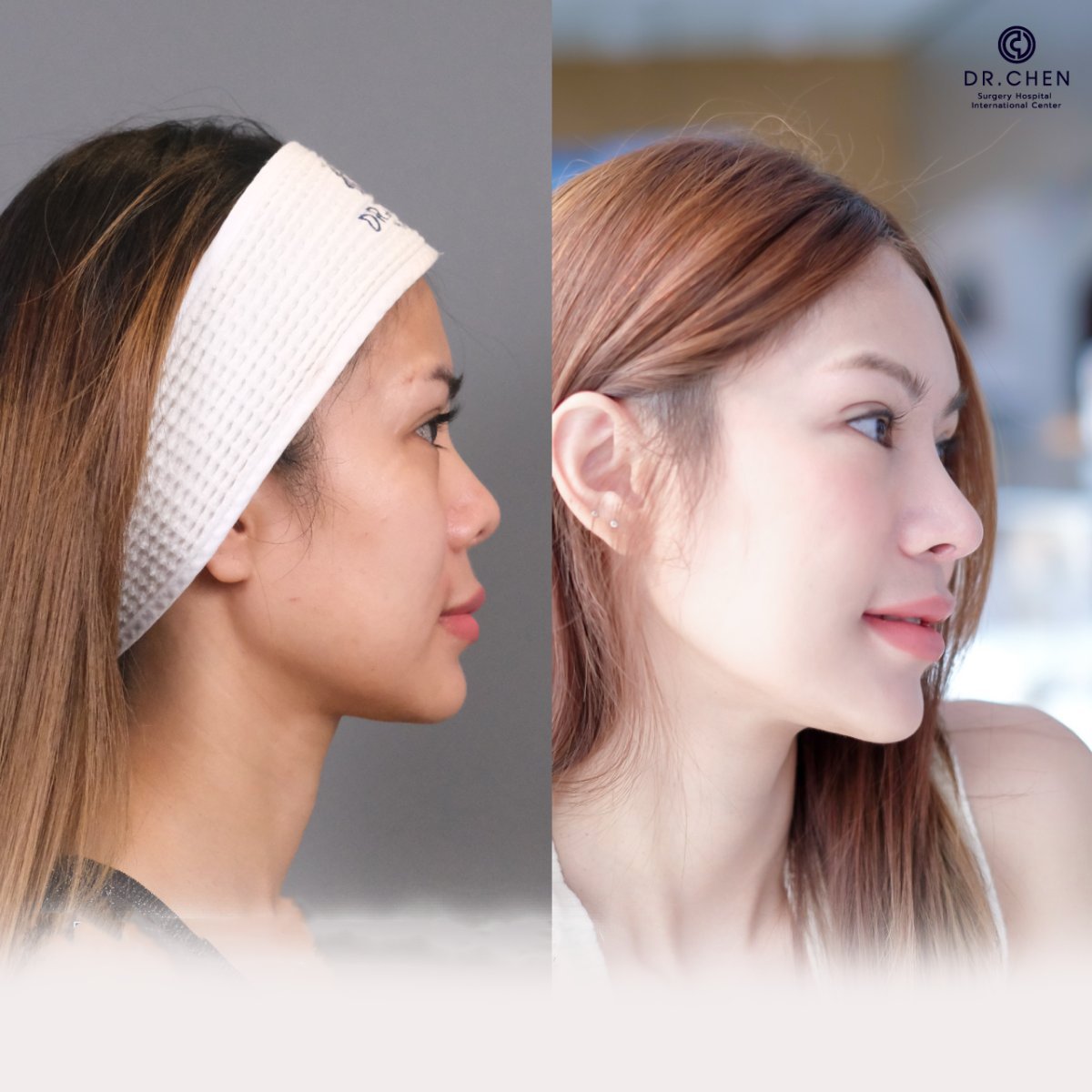 نتيجة قبل وبعد تجميل الأنف بالموجات فوق الصوتية في Dr. Chen Surgery Hospital International Center