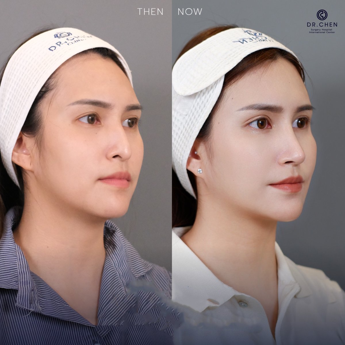 Результат до и после ультразвуковой ринопластики в Dr. Chen Surgery Hospital International Center