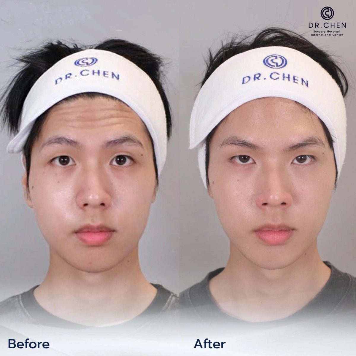 نتيجة قبل وبعد حقن البوتوكس في Dr. Chen Surgery Hospital International Center