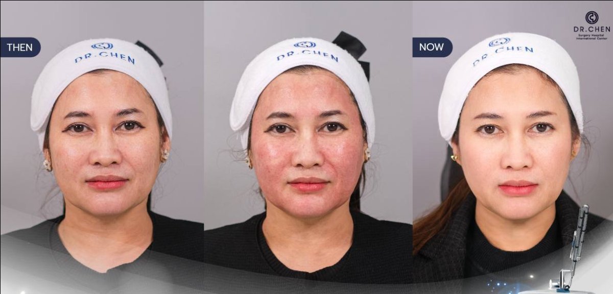 Before and after laser skin resurfacing results at Dr. Chen Surgery Hospital International Center