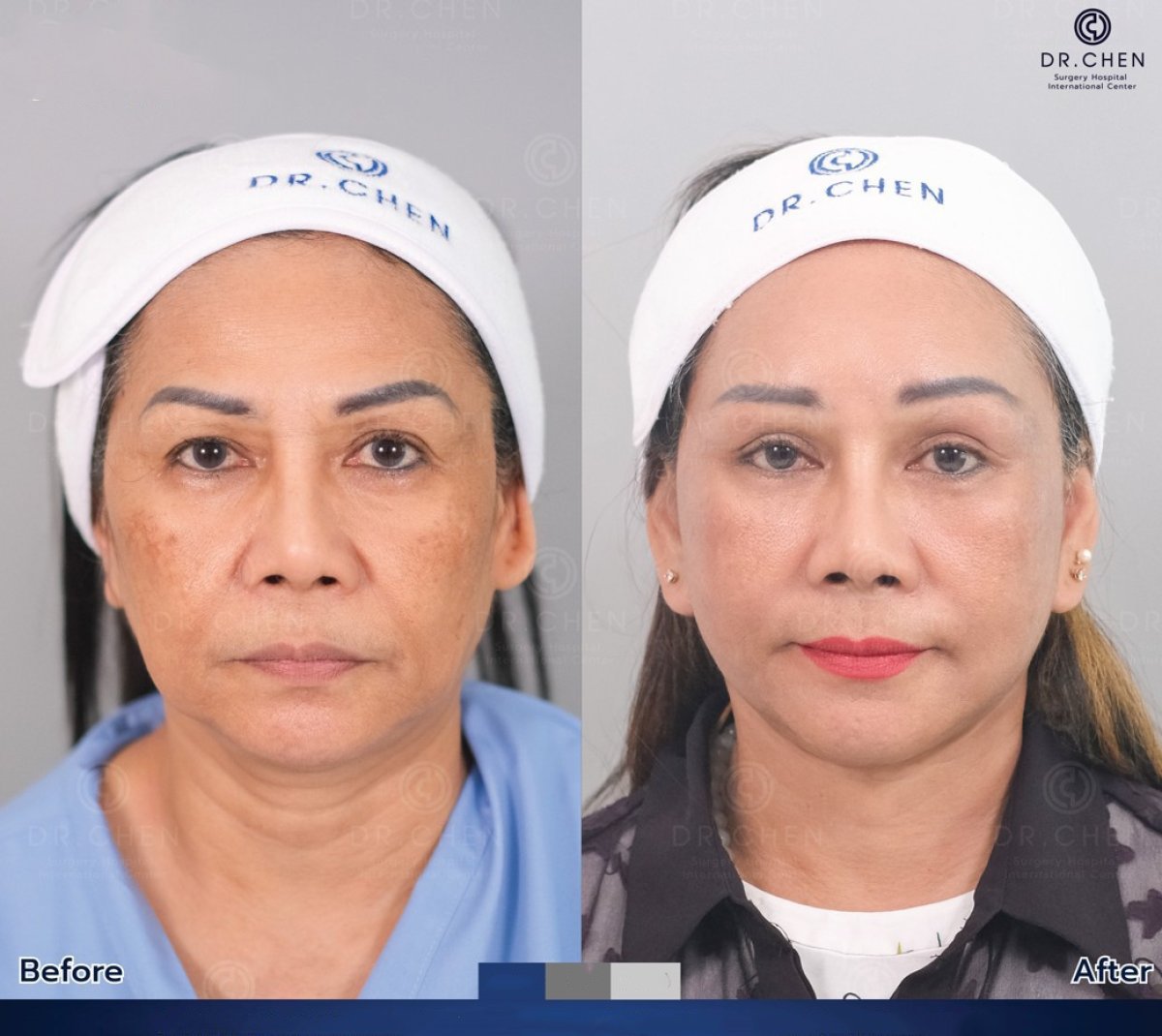 Resultados antes y después de lifting de cuello en Dr. Chen Surgery Hospital International Center, rejuvenecimiento