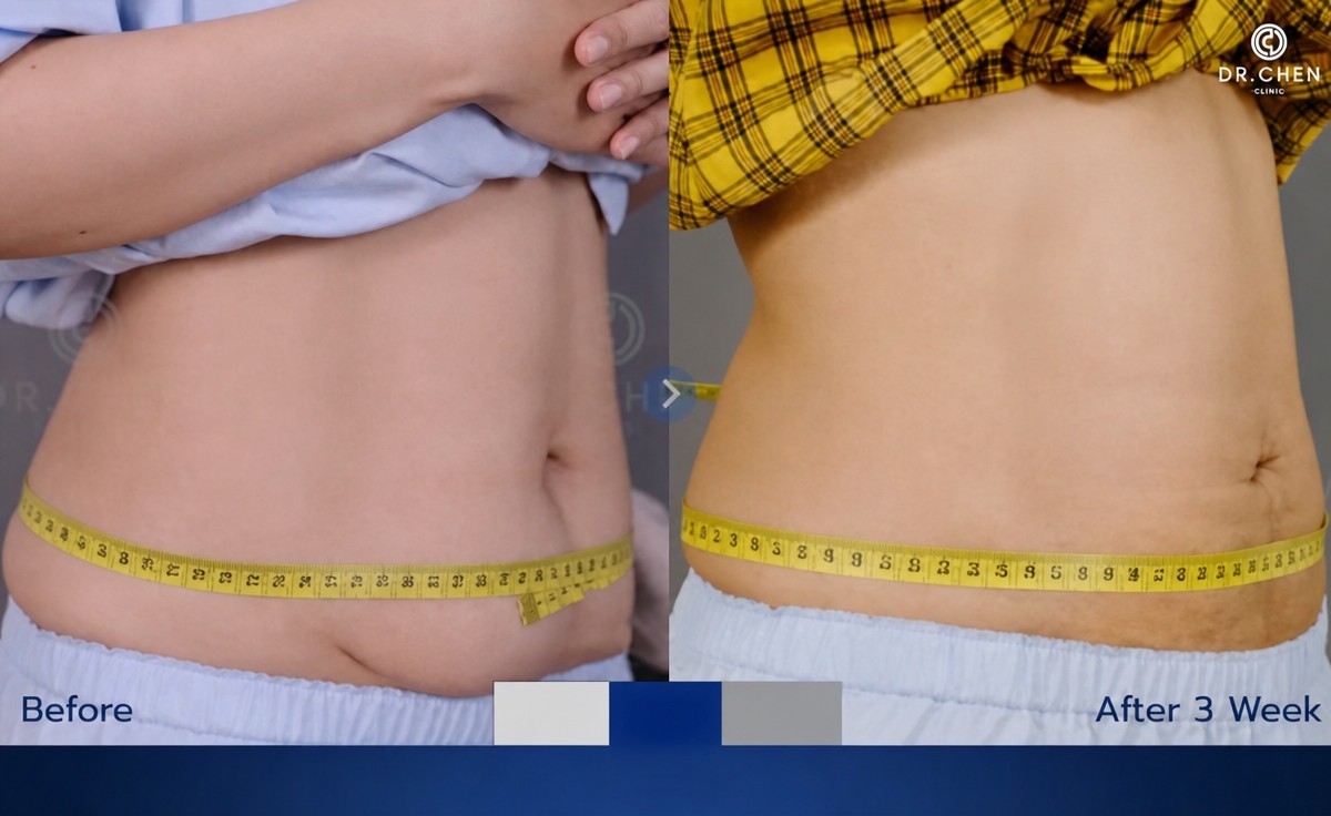 Before and after liposuction results at Dr. Chen Surgery Hospital International Center, slimmer waist