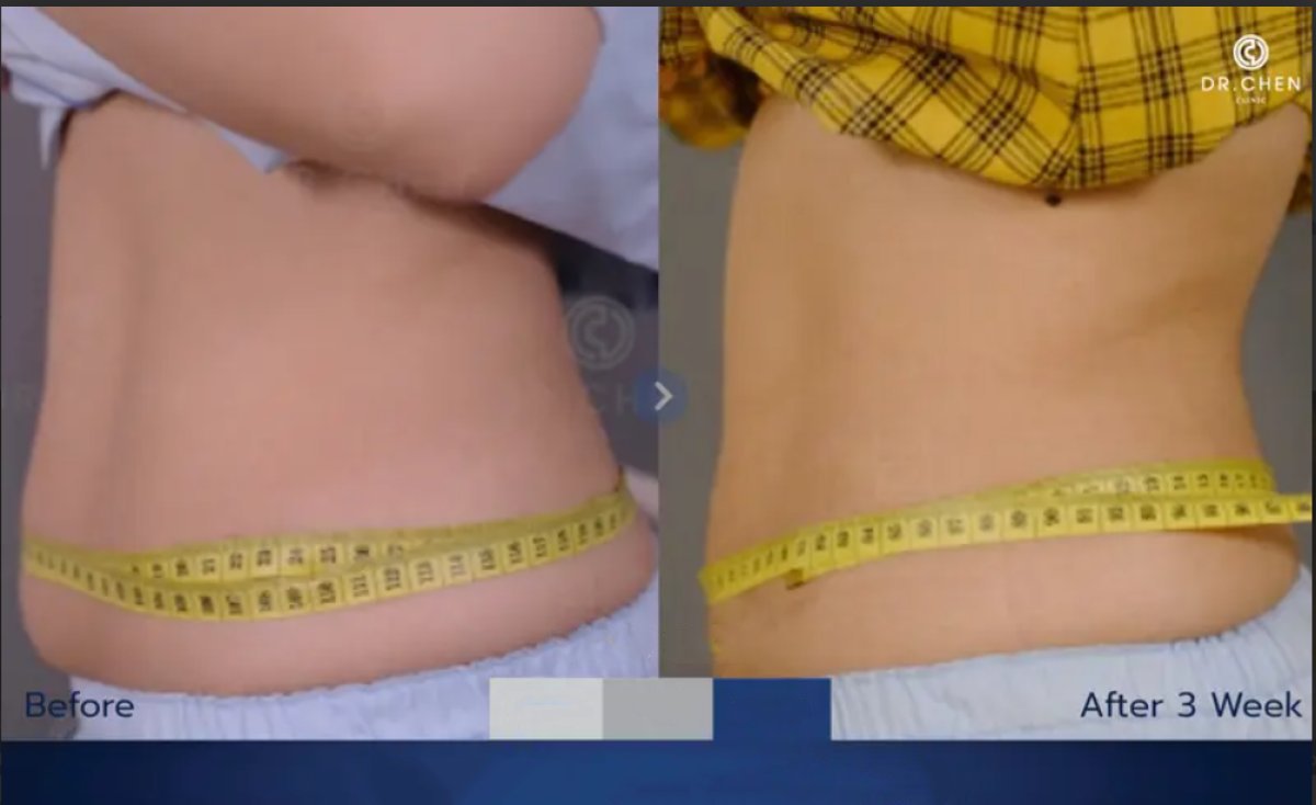 نتائج شفط الدهون قبل وبعد في Dr. Chen Surgery Hospital International Center، تحديد الخصر
