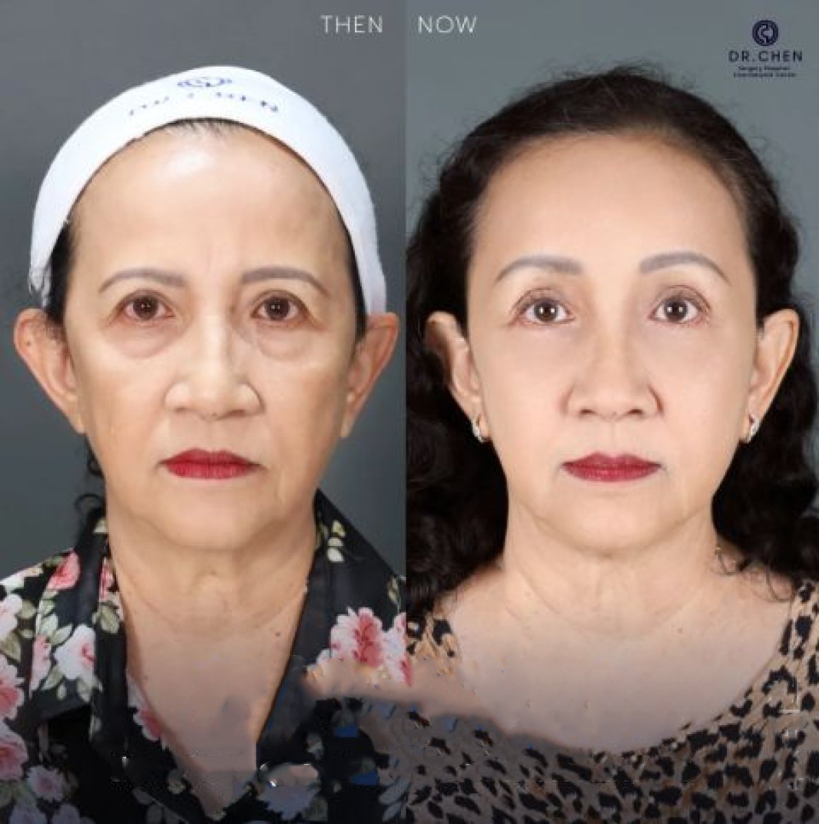 Resultados de transferencia de grasa facial antes y después en Dr. Chen Surgery Hospital