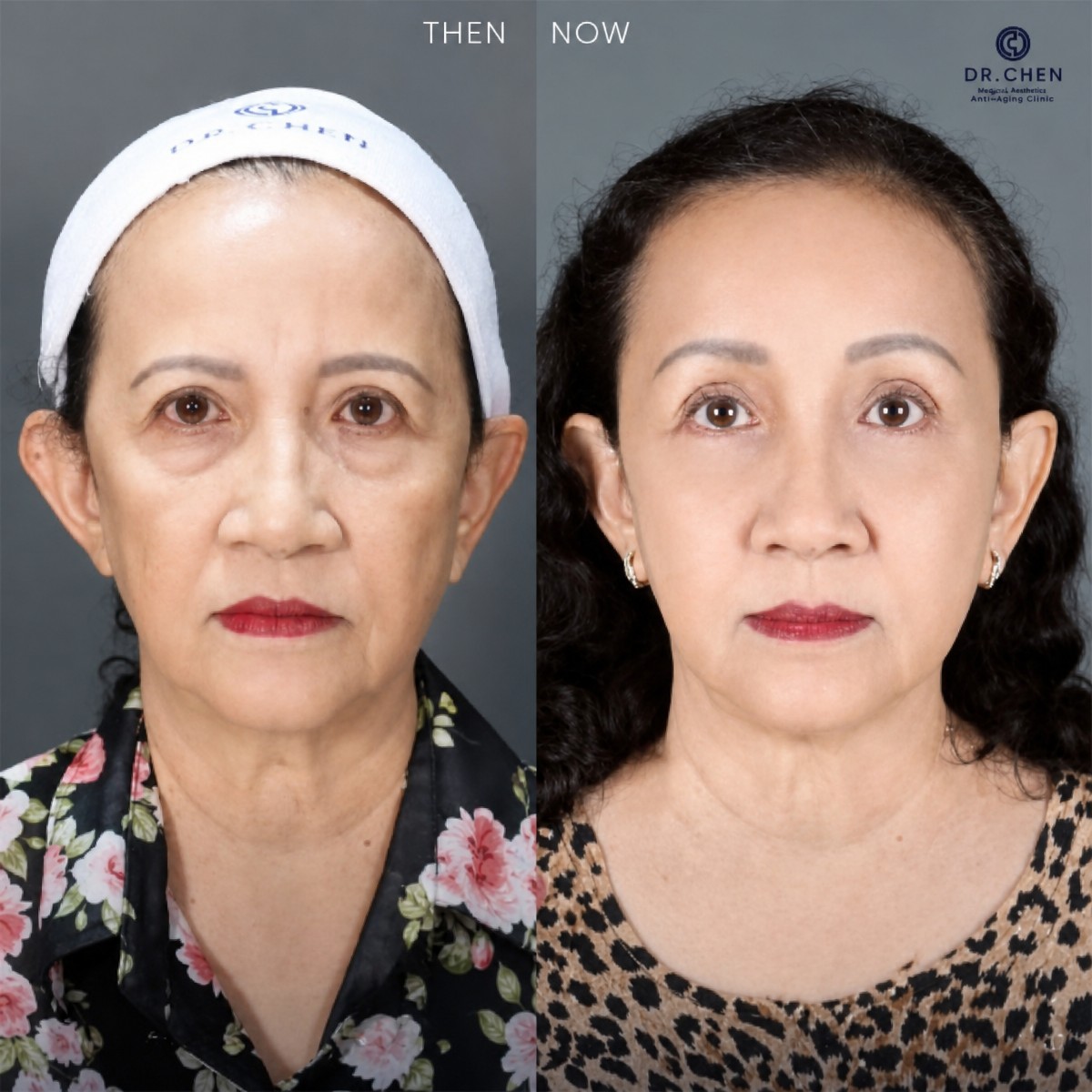 Результаты блефаропластики нижних век до и после в Dr. Chen Surgery Hospital International Center