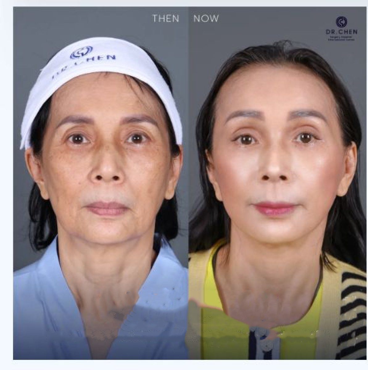 Resultados de transferencia de grasa facial antes y después en Dr. Chen Surgery Hospital International Center