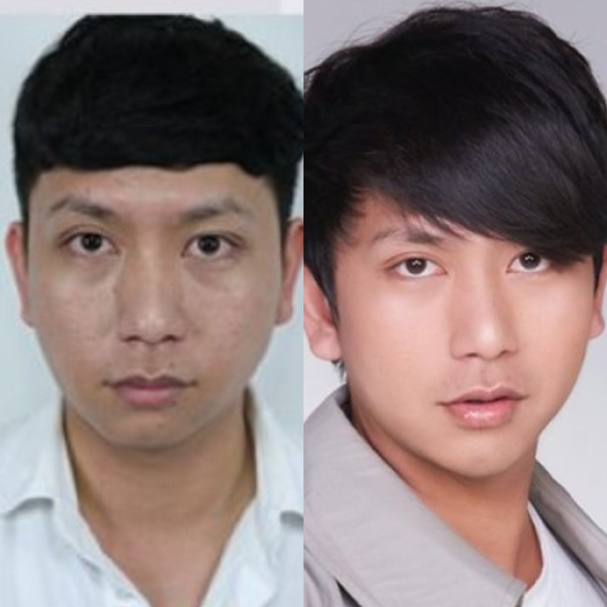 Antes y después de inyecciones de relleno en Dr. Chen Clinic, resultado rejuvenecedor
