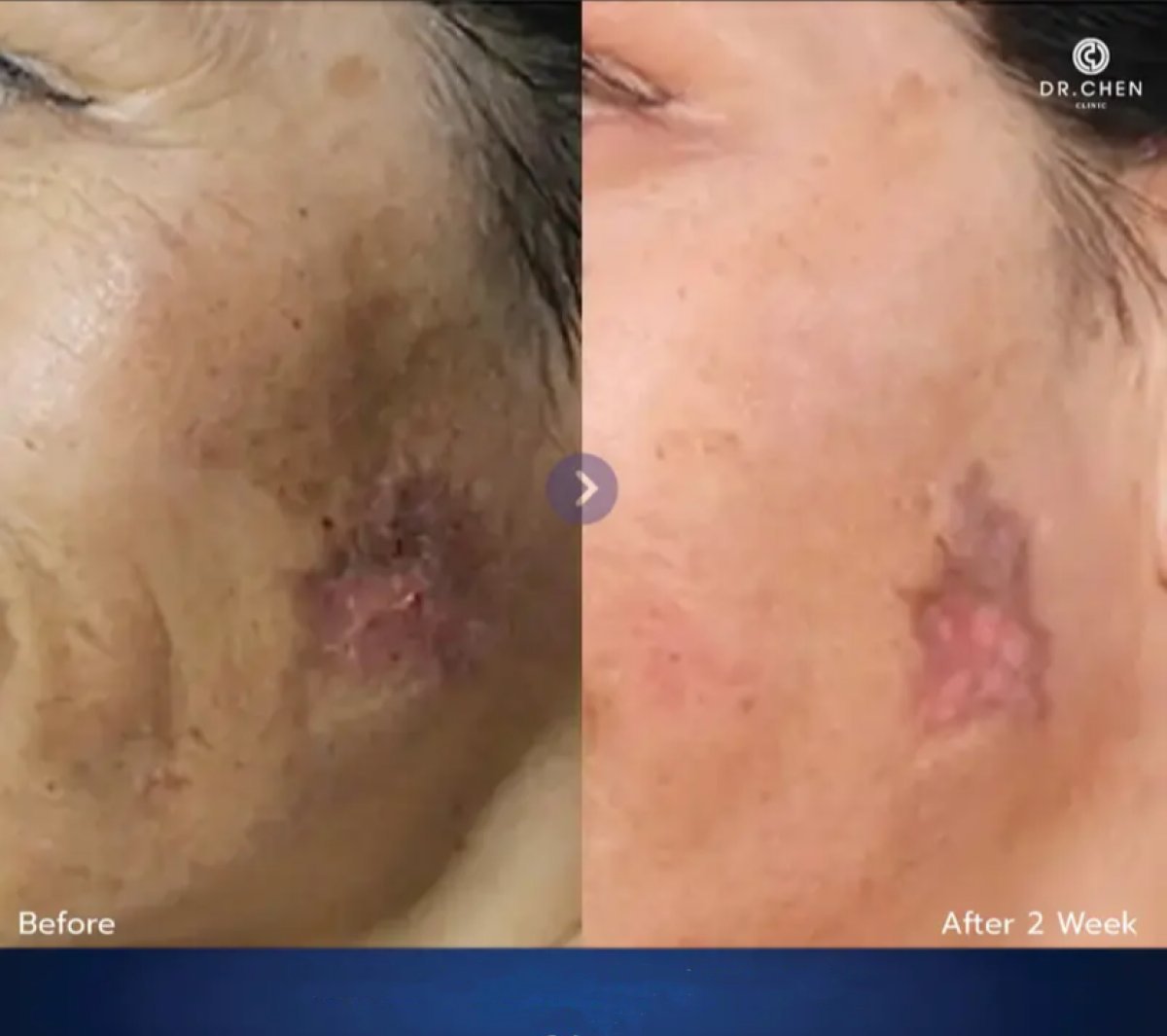 Resultados antes y después de terapia con células madre en Dr. Chen Clinic para cicatrices faciales