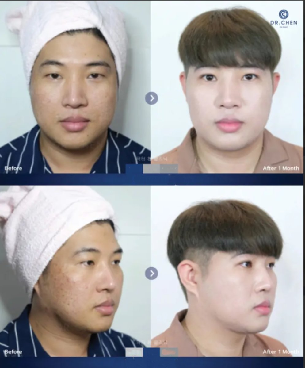 Resultados de Skinbooster antes y después en Dr. Chen Clinic: mejora de la textura facial
