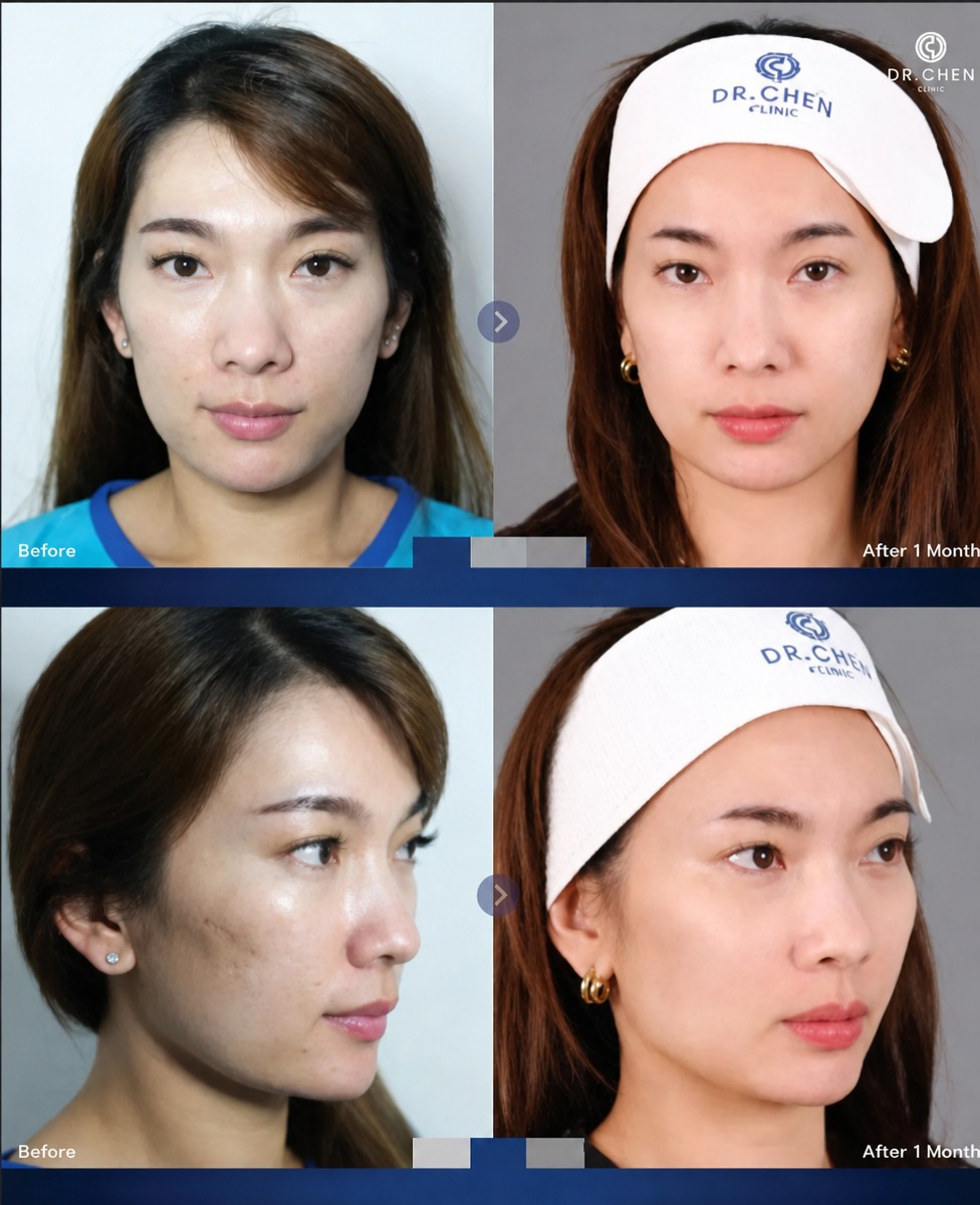 Before and after Skinbooster treatment results at Dr. Chen Clinic, improved skin texture