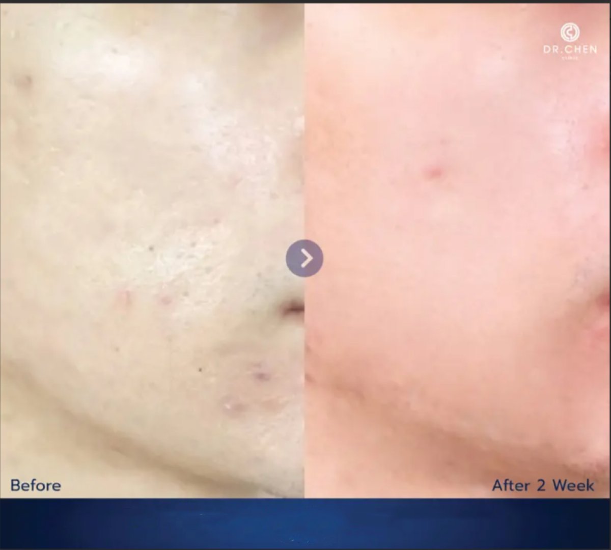 Resultados antes y después de Skinbooster en Dr. Chen Clinic, mejora de la textura facial