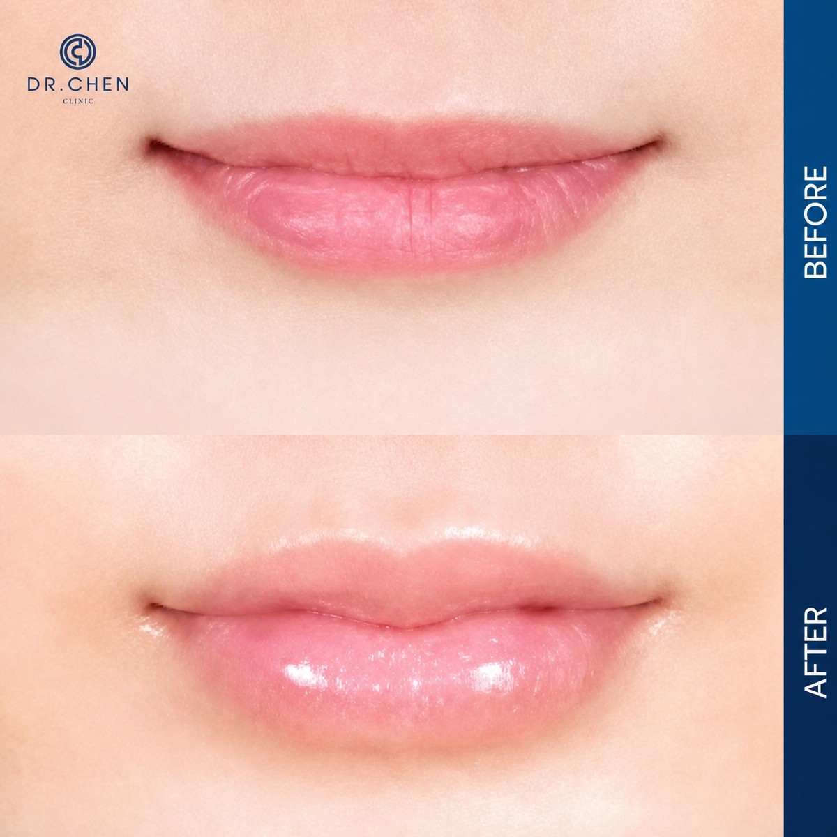 Antes y después de rellenos en Dr. Chen Clinic, aumento de volumen y contorno labial