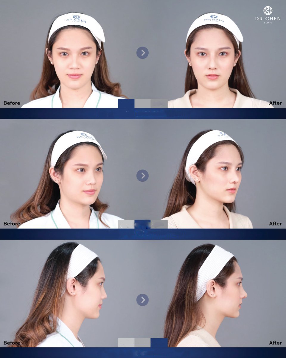 Before and after rhinoplasty results at Dr. Chen Clinic, nose reshaping with natural look