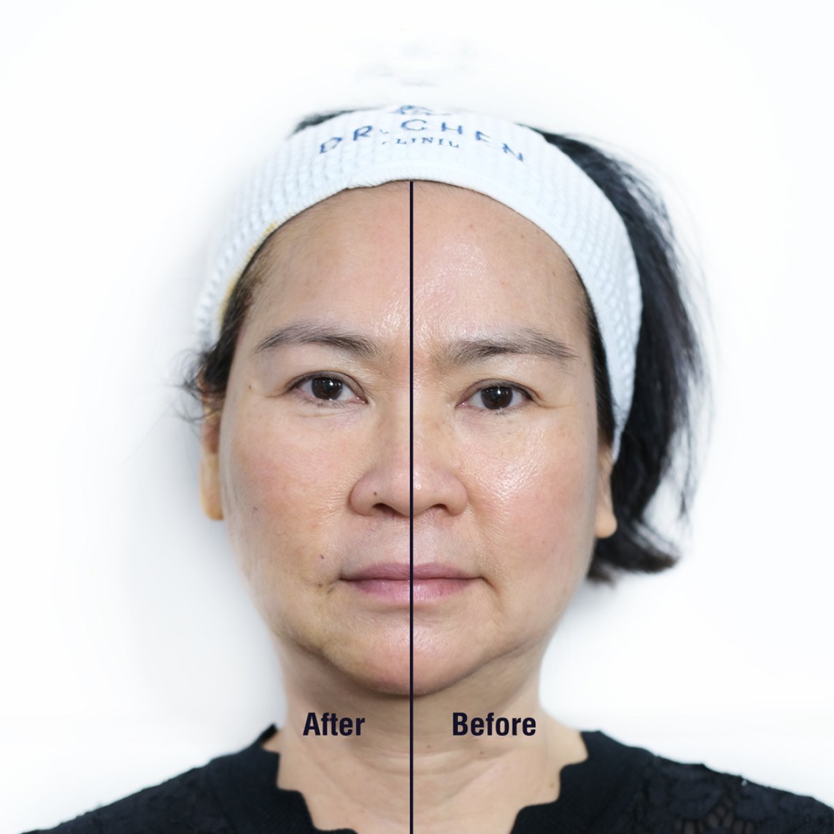 Before and after hyaluronic acid threads lifting result at Dr. Chen Clinic, facial rejuvenation