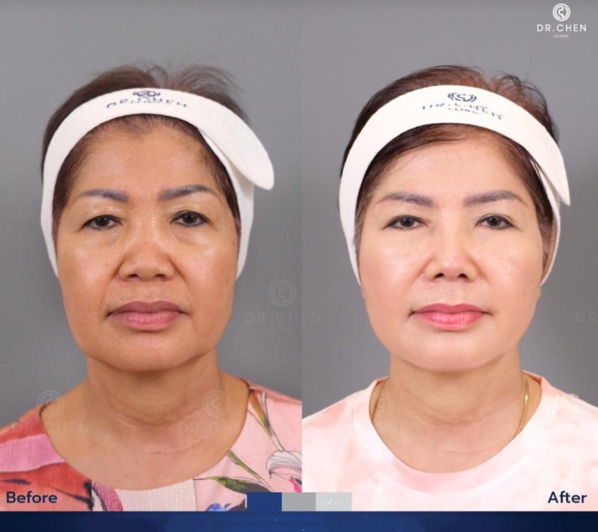 Before and after Skinbooster treatment at Dr. Chen Clinic, facial rejuvenation results