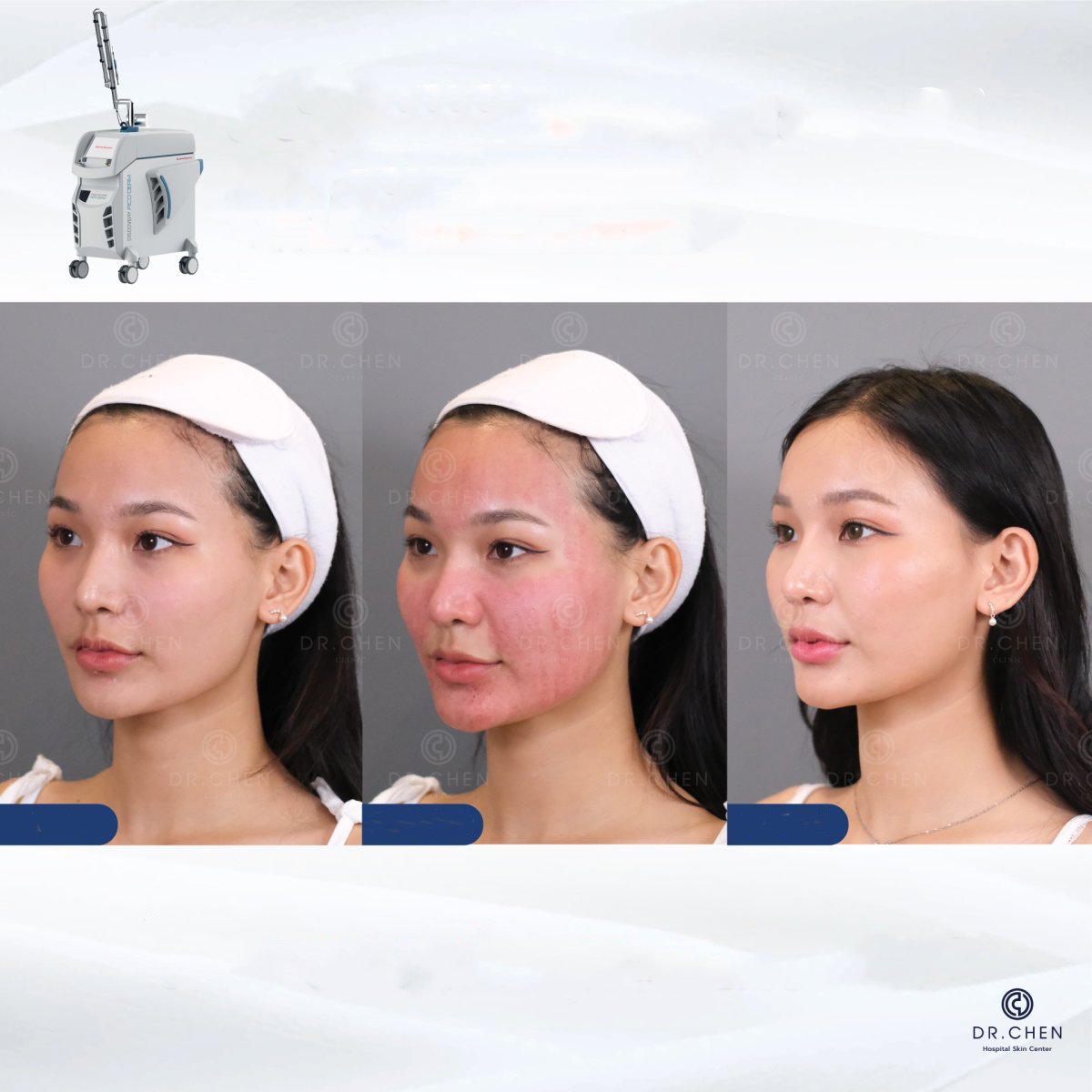 Resultados antes y después de resurfacing láser facial en Dr. Chen Clinic, piel mejorada