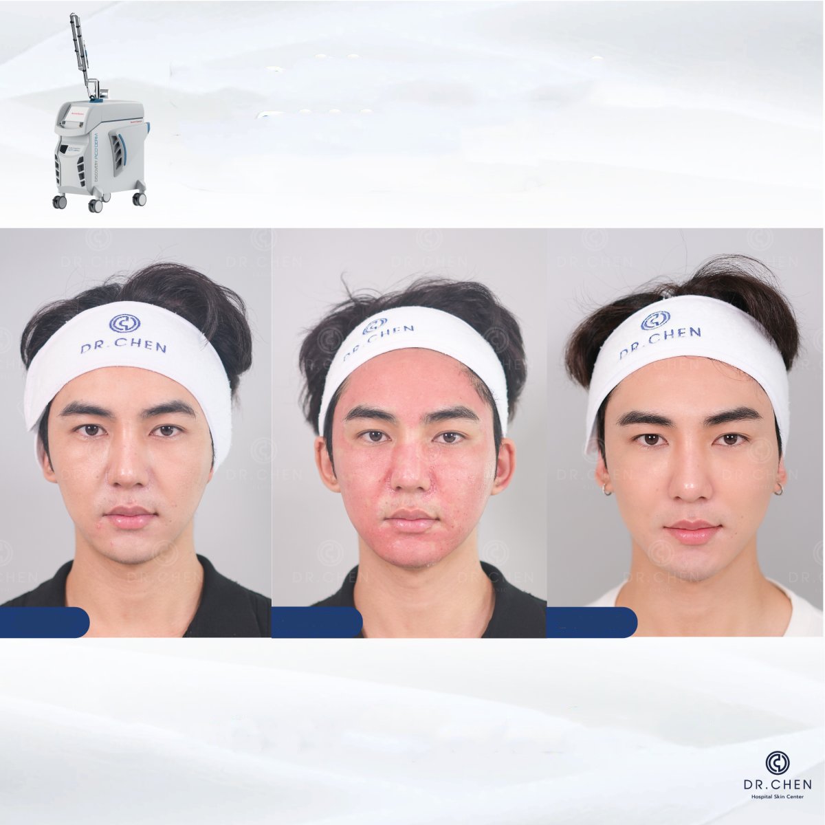 Résultats avant/après resurfaçage laser visage à la clinique Dr. Chen, texture peau améliorée
