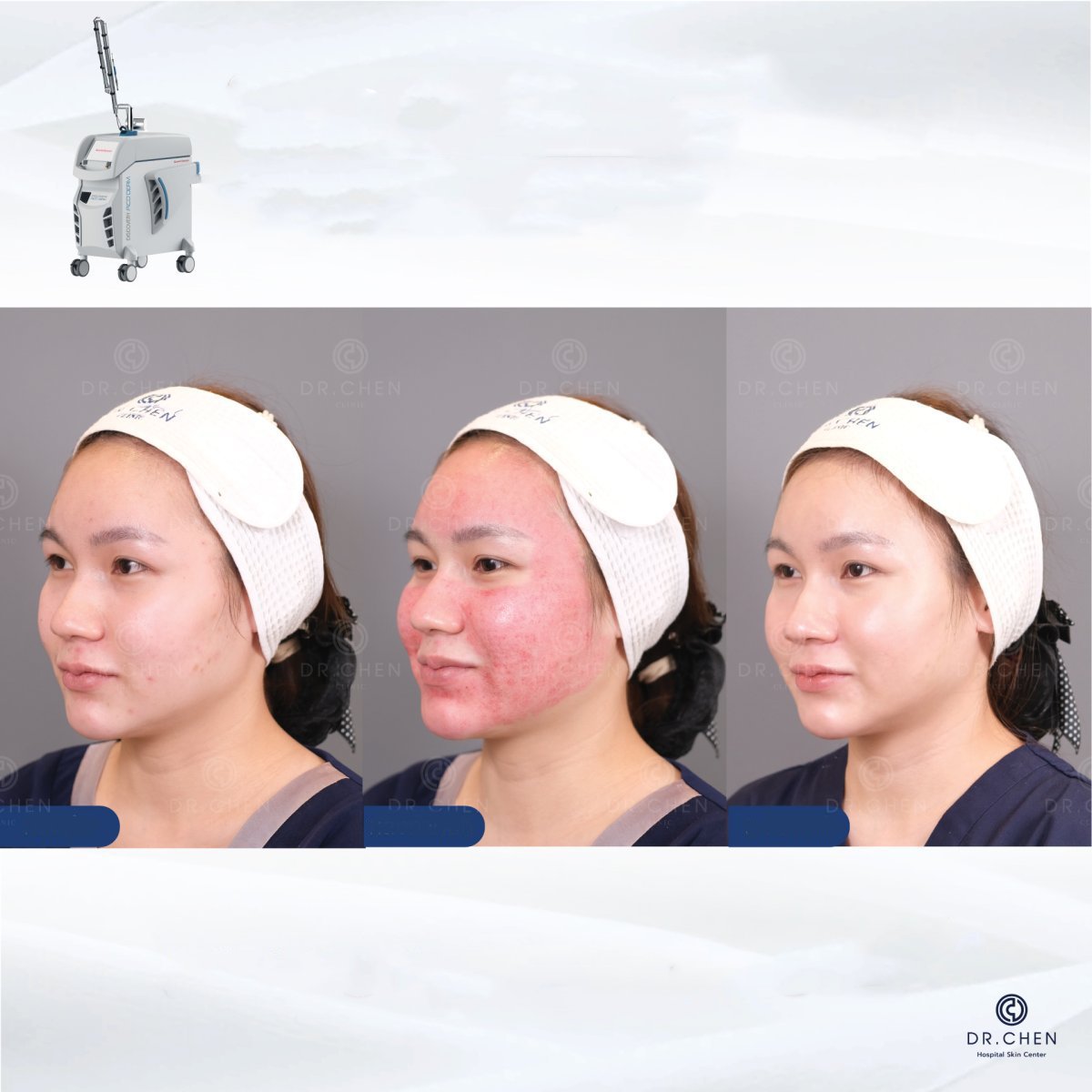 Laser skin resurfacing before and after results at Dr. Chen Clinic, improved facial skin texture