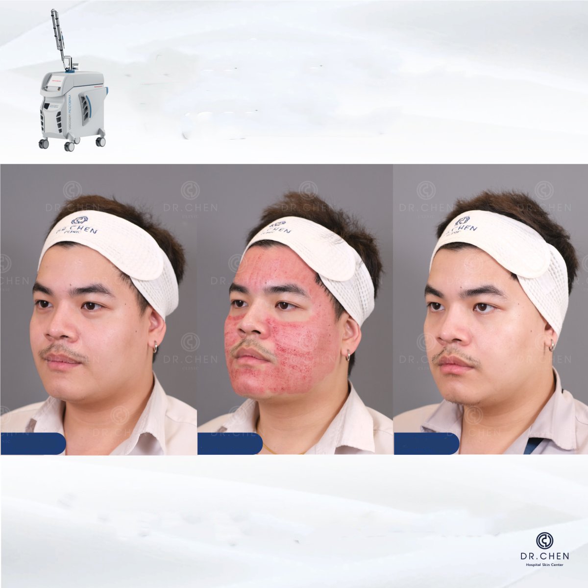 Efekty laserowego resurfacingu twarzy przed i po w klinice Dr. Chen, odmłodzenie skóry