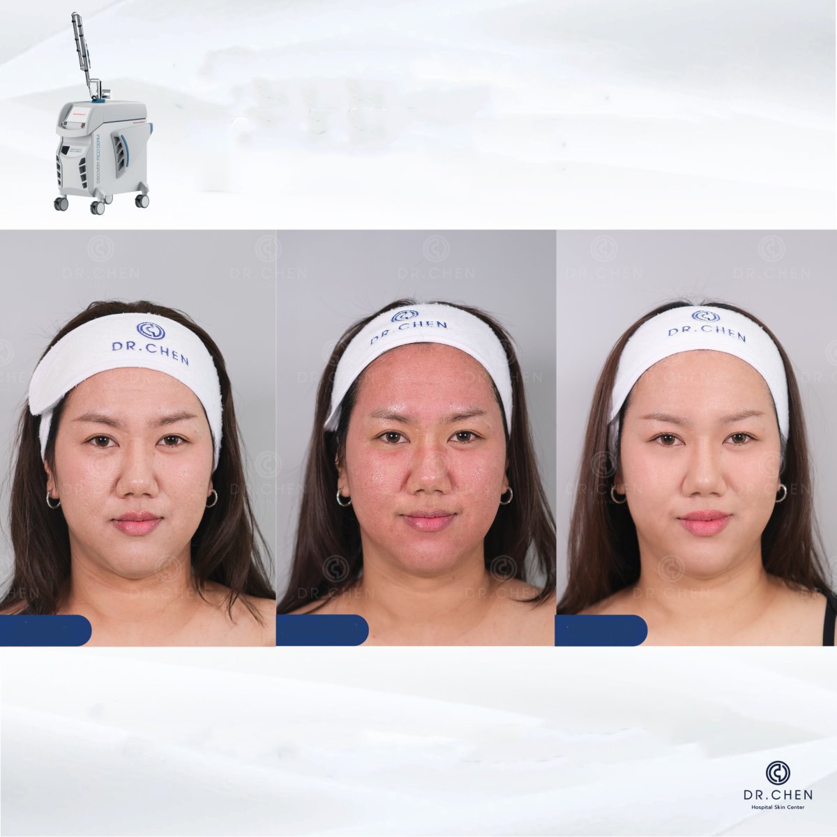 Laser skin resurfacing before and after results at Dr. Chen Clinic, improved facial skin texture