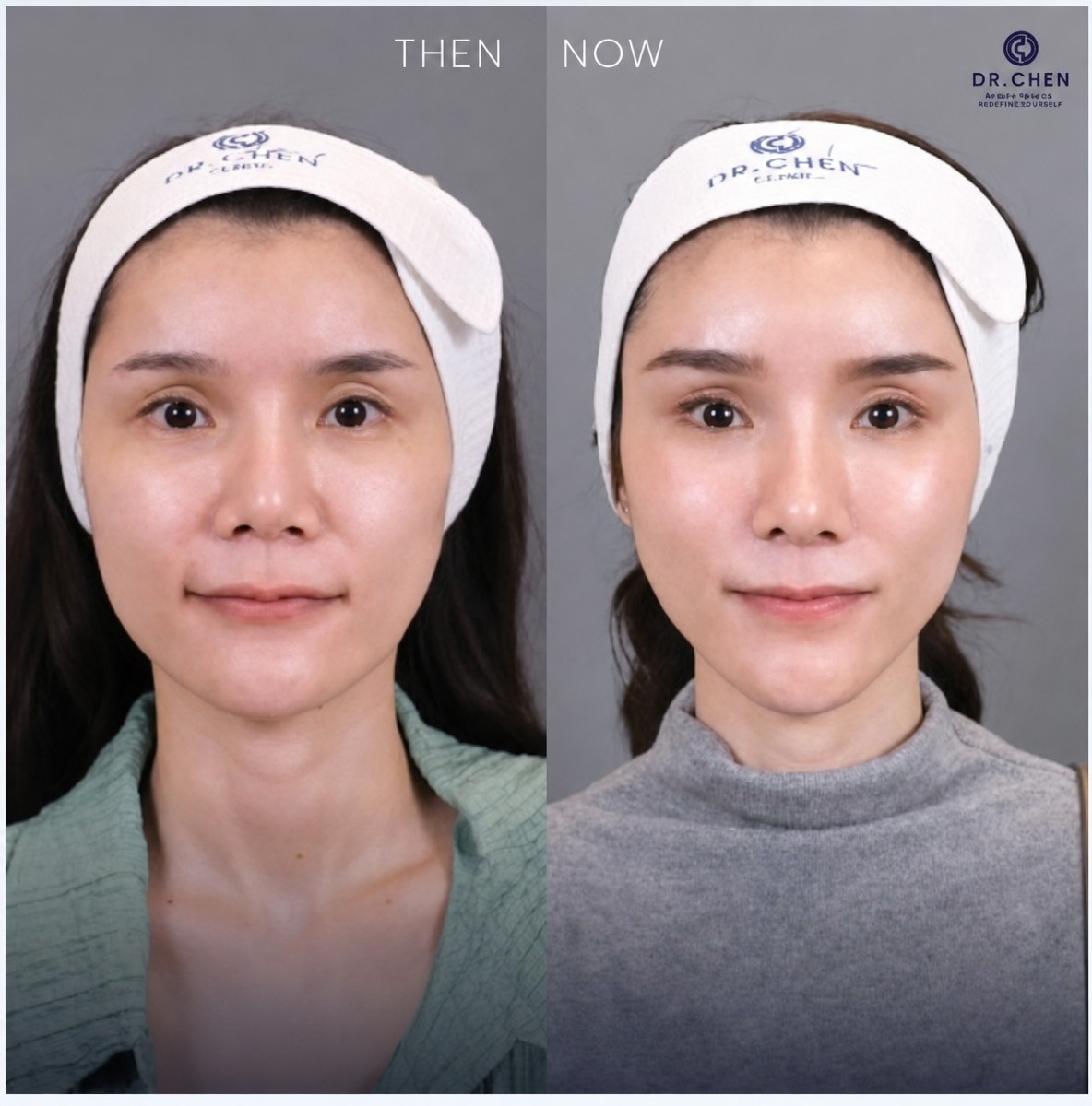 Resultados de Ultherapy antes y después en Dr. Chen Clinic: efecto visible de lifting facial