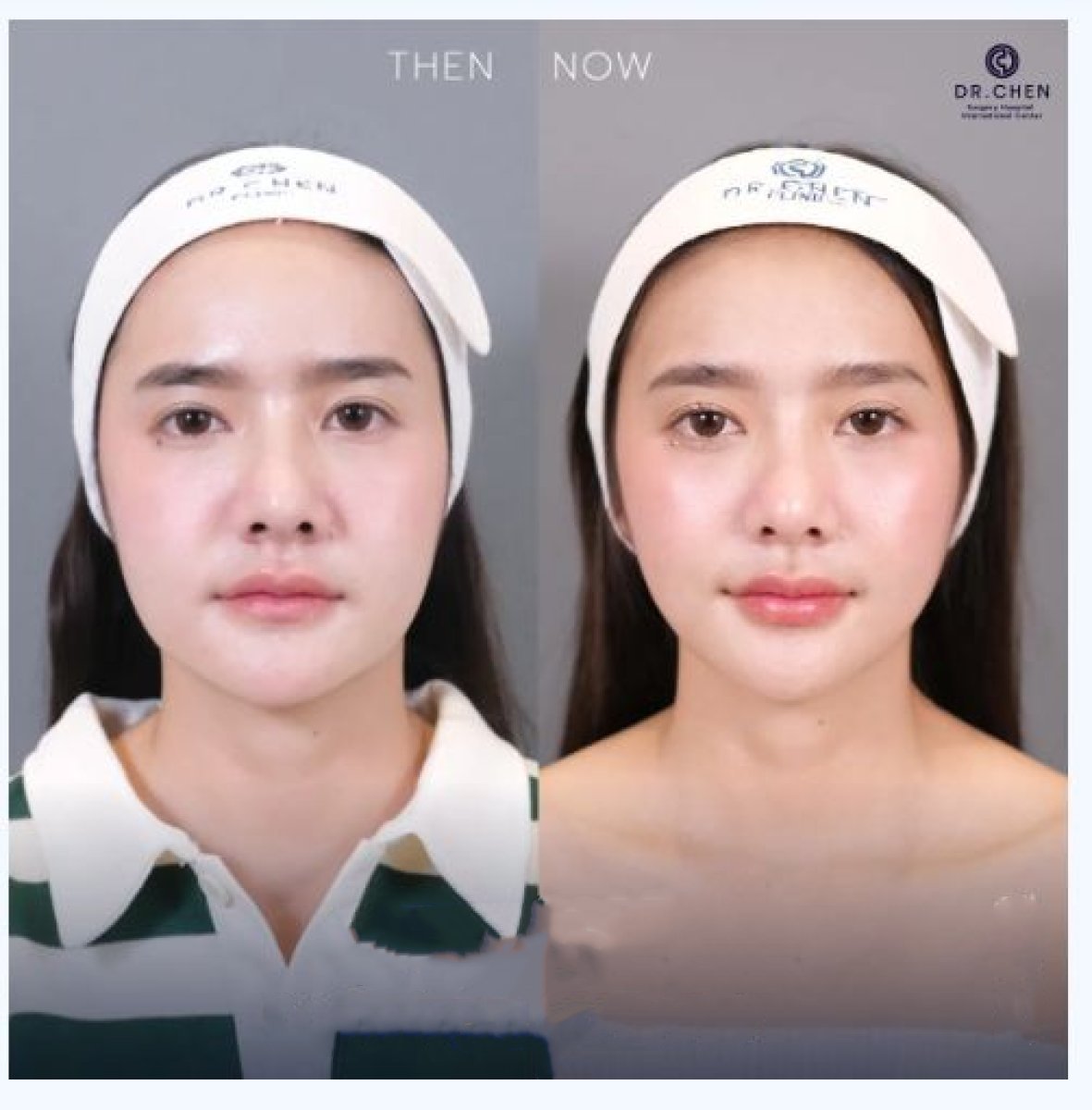 Результаты до и после Ultherapy в клинике Dr. Chen – видимый лифтинг кожи лица