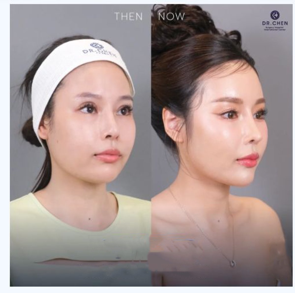 نتائج قبل وبعد علاج Ultherapy في عيادة Dr. Chen – شد ورفع واضح للوجه