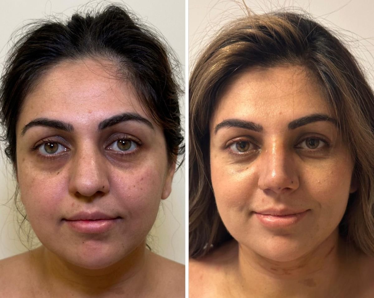 نتائج قبل وبعد عملية تجميل الأنف التصحيحية في عيادة Dr. Safa Manav، تحسين شكل الأنف