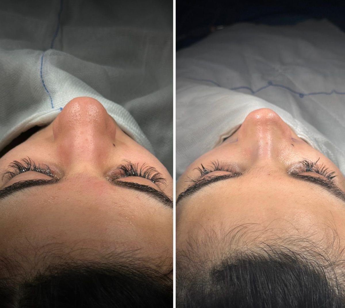 نتيجة قبل وبعد تجميل الأنف التصحيحي في عيادة Dr. Safa Manav، تحسين شكل الأنف