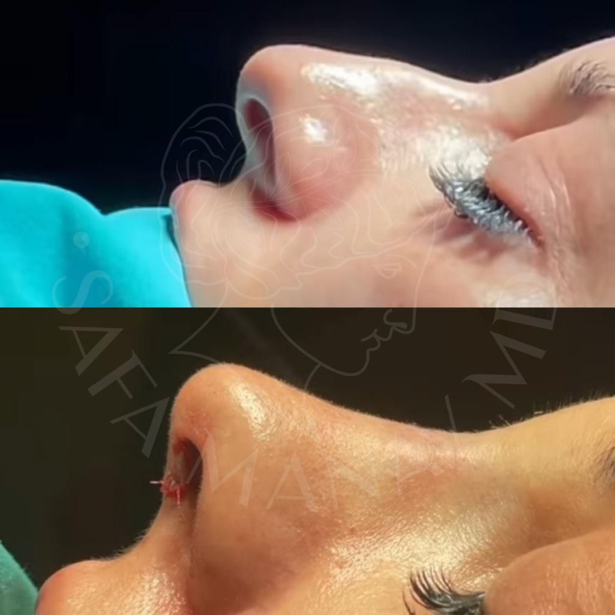 نتائج قبل وبعد عملية تجميل الأنف التصحيحية في عيادة د. صفا مناف، تحسين شكل الأنف