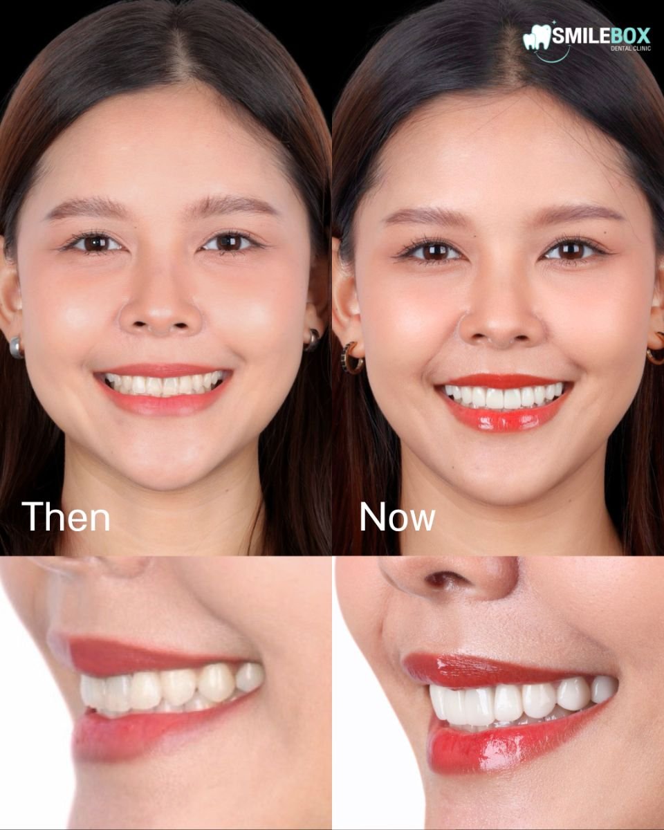 Результат до і після встановлення вінірів у SmileBox Dental Clinic - Thonglor, Sukhumvit Branch