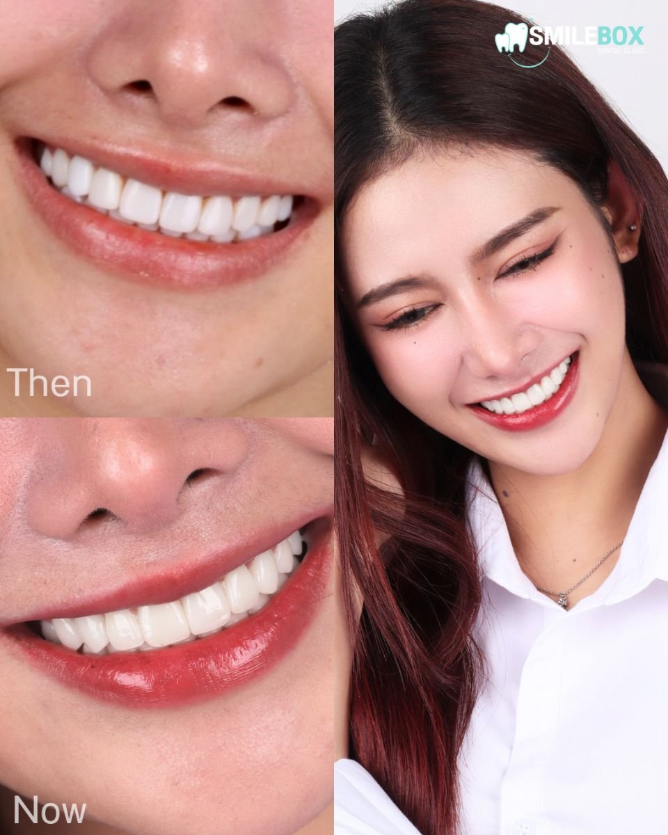 Efekt przed i po licówkach w SmileBox Dental Clinic - Thonglor, Sukhumvit Branch