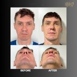 Résultats de la procédure Rhinoplastie (travail du nez) par le Dr Dr Phatcharasak Kraisornphongsakul Md - Photos avant et après des patients Photos avant et après par le Dr Dr Phatcharasak Kraisornphongsakul Md