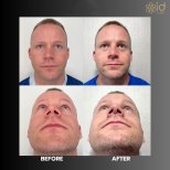 Résultats de la procédure Rhinoplastie (travail du nez) par le Dr Dr Phatcharasak Kraisornphongsakul Md - Photos avant et après des patients Photos avant et après par le Dr Dr Phatcharasak Kraisornphongsakul Md