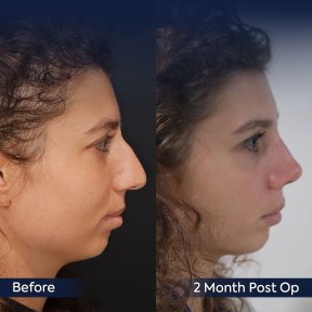 Premium Rhinoplasty (nose job) All Included - photo 6