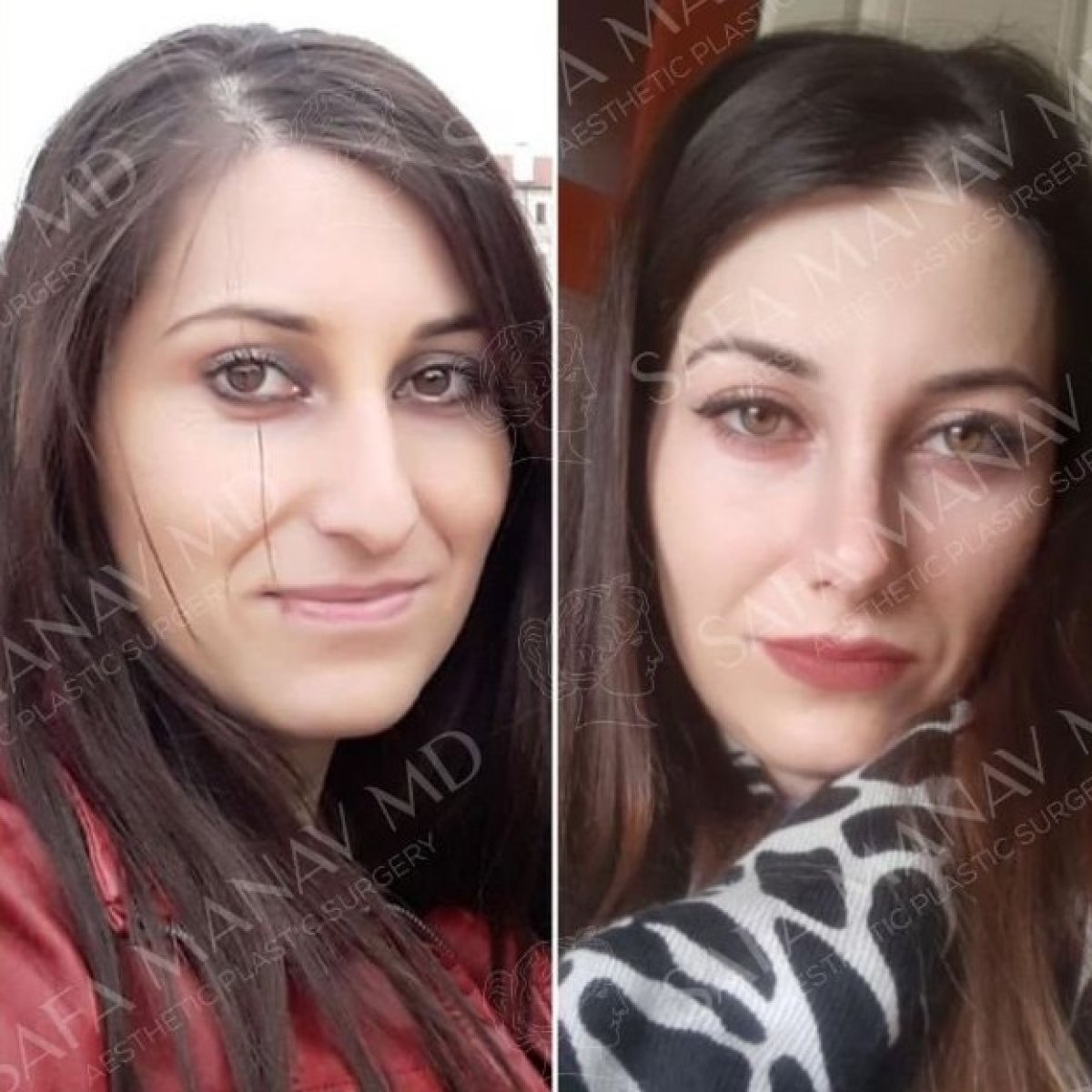 نتائج تجميل الأنف التصحيحي قبل وبعد في عيادة Dr. Safa Manav، تحسين شكل الأنف