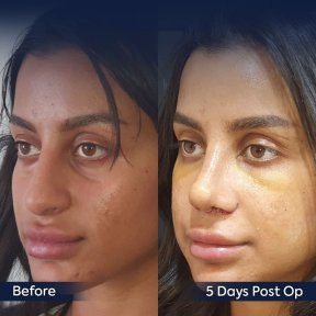 Premium Rhinoplasty (nose job) All Included - photo 5