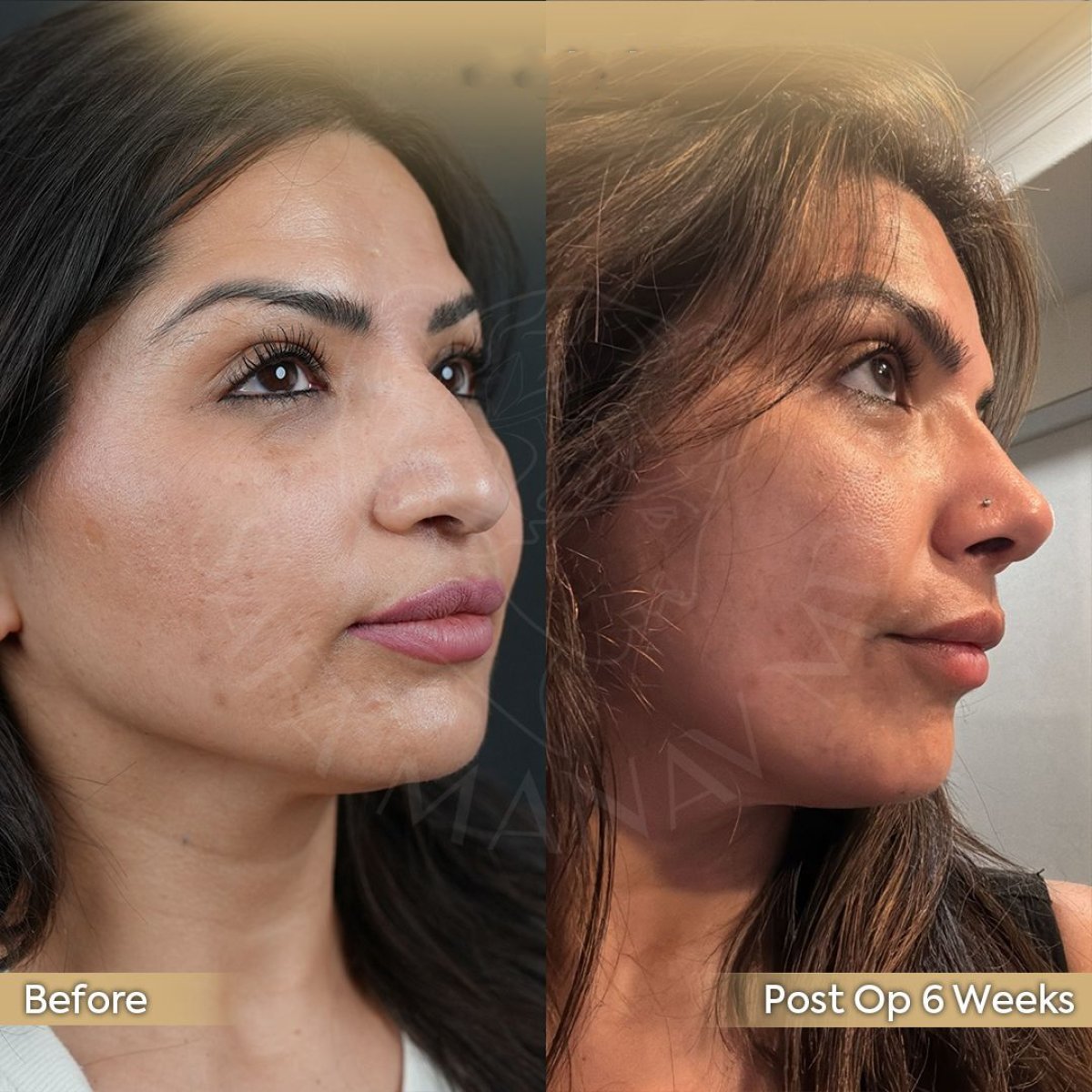 نتيجة قبل وبعد عملية تجميل الأنف التصحيحية في عيادة Dr. Safa Manav بعد 6 أسابيع