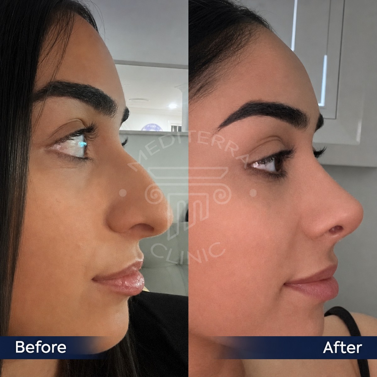 نتائج قبل وبعد عملية تجميل الأنف التصحيحية في عيادة Dr. Safa Manav، تحسين شكل الأنف