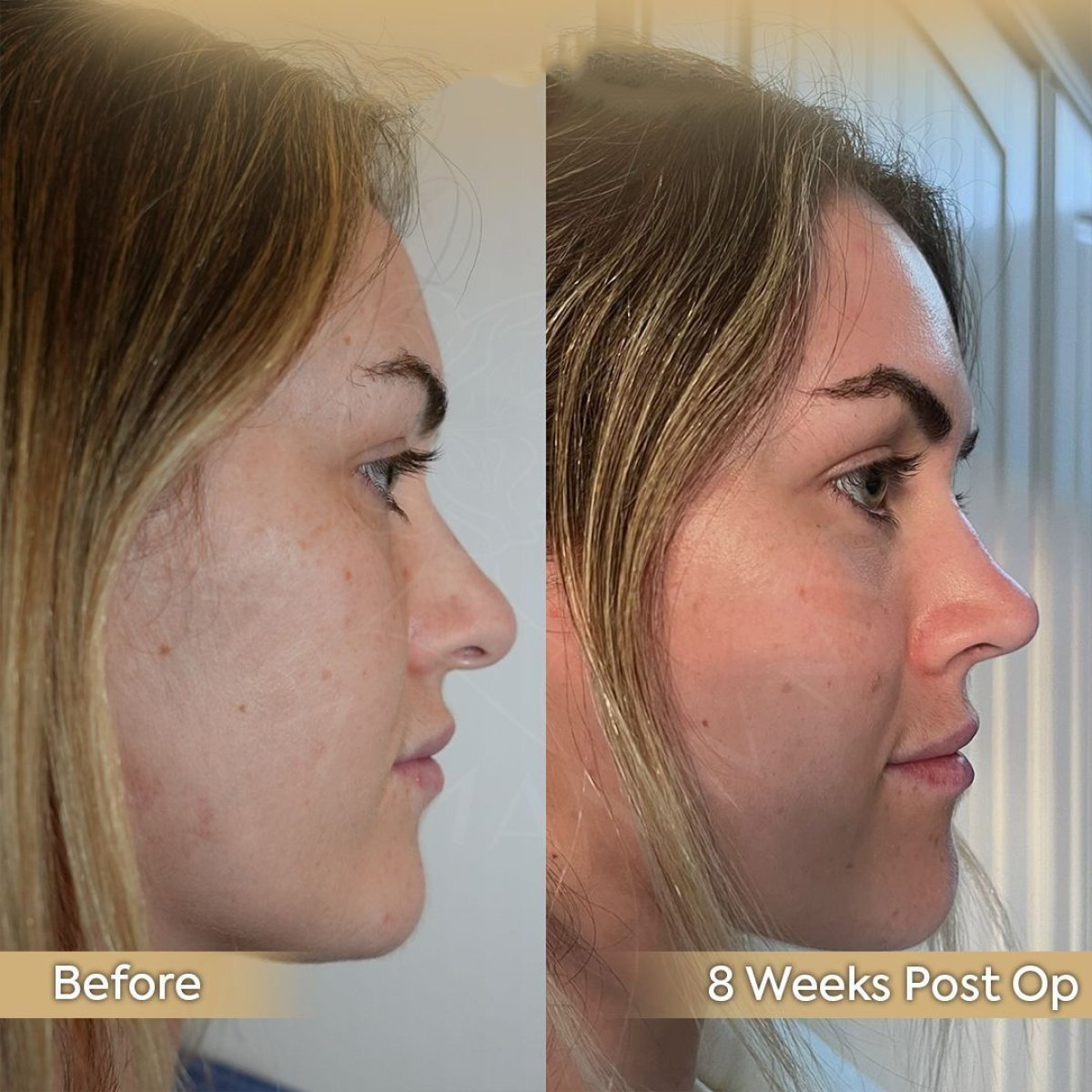 Résultats avant/après rhinoplastie secondaire à la Dr. Safa Manav Clinic, profil du nez amélioré