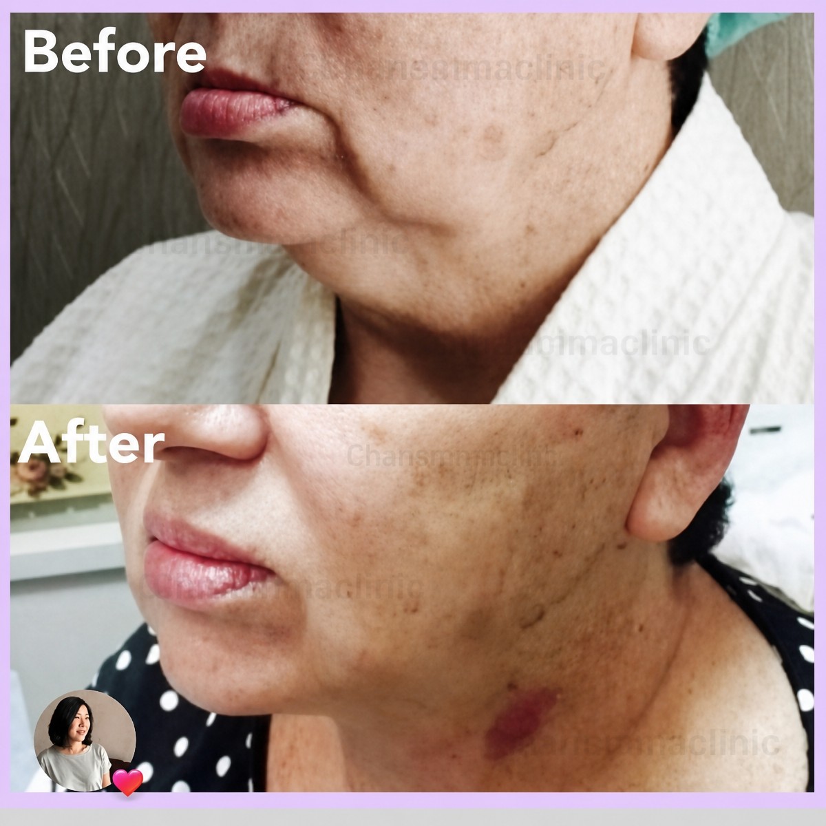 Resultados antes y después de liposucción láser en Charismma Clinic, contorno mejorado