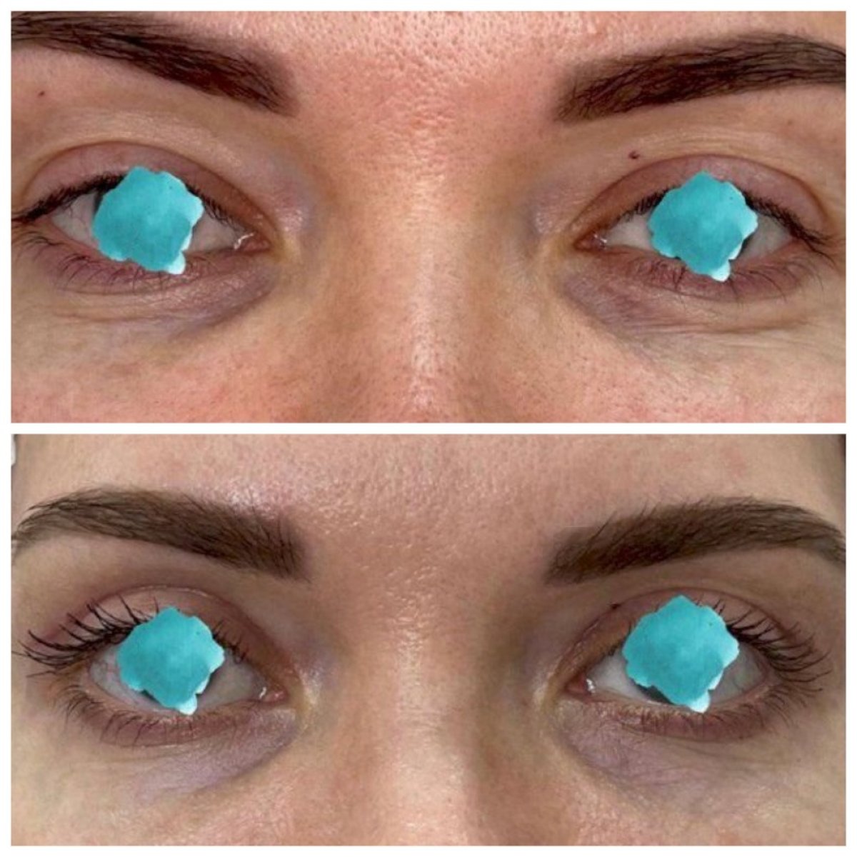 Resultados de blefaroplastia de párpado inferior antes y después en Altos Clinic, menos bolsas