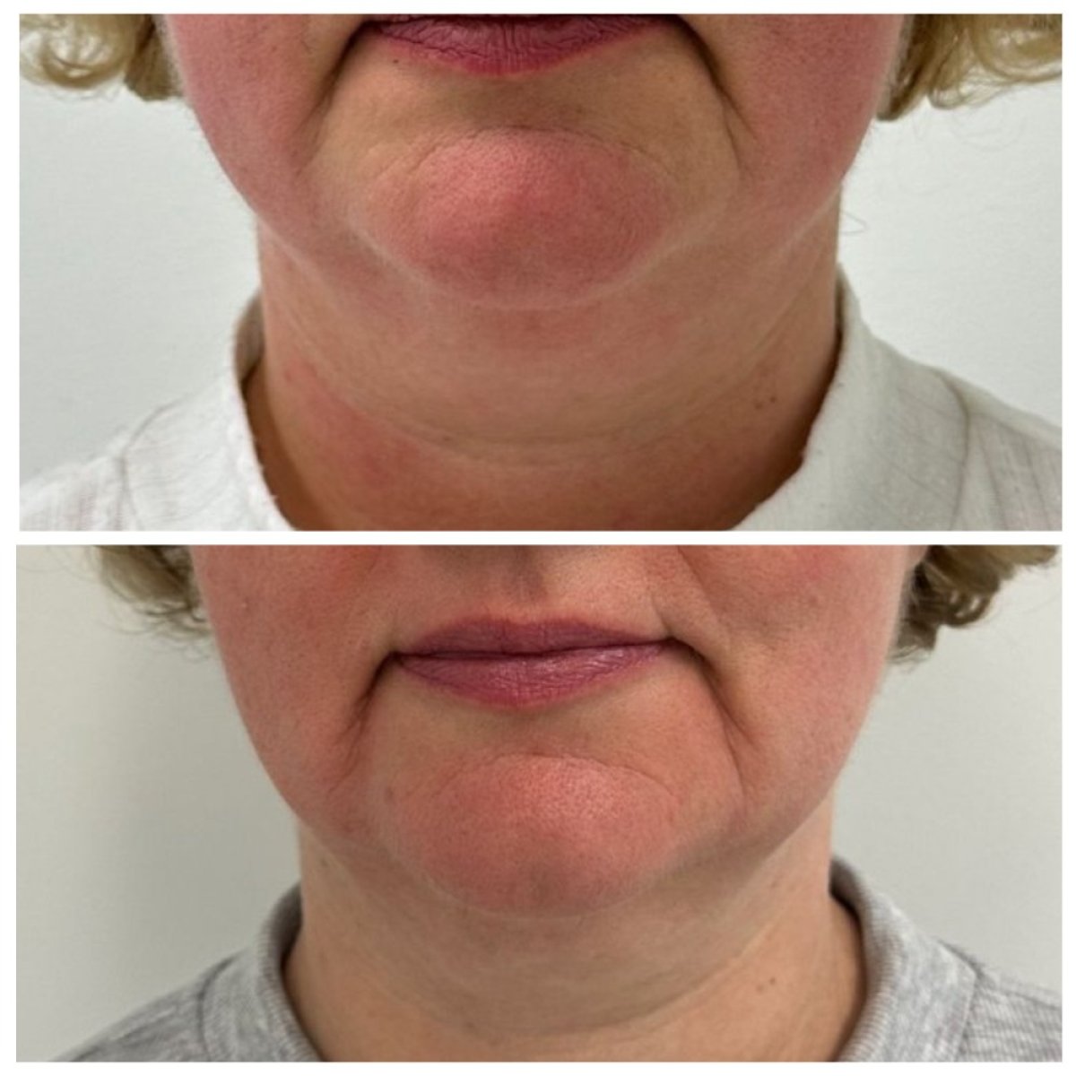 Resultados de liposucción facial antes y después en Altos Clinic, contorno mejorado